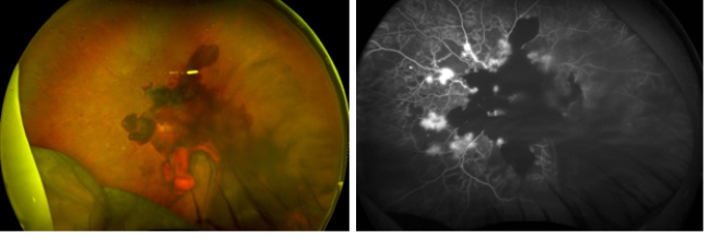 左：黄斑部に目立つ硝子体出血 右：無灌流領域と新生血管、硝子体出血