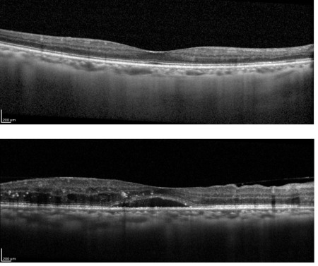 上：正常OCT画像 下：糖尿病黄斑浮腫