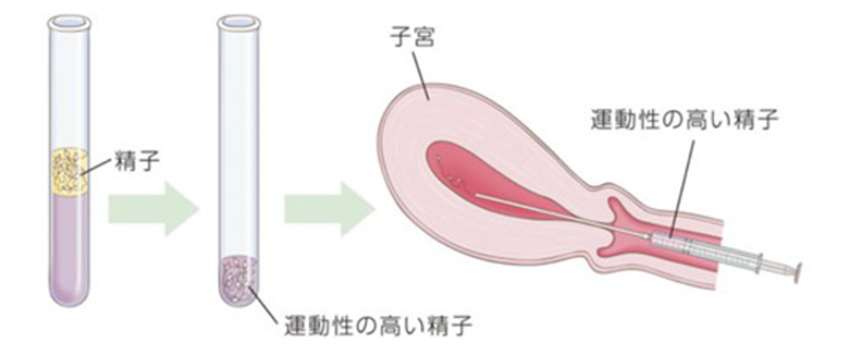 一般不妊治療