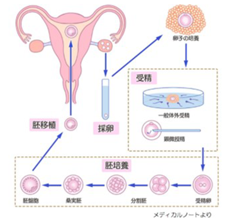 生殖補助医療