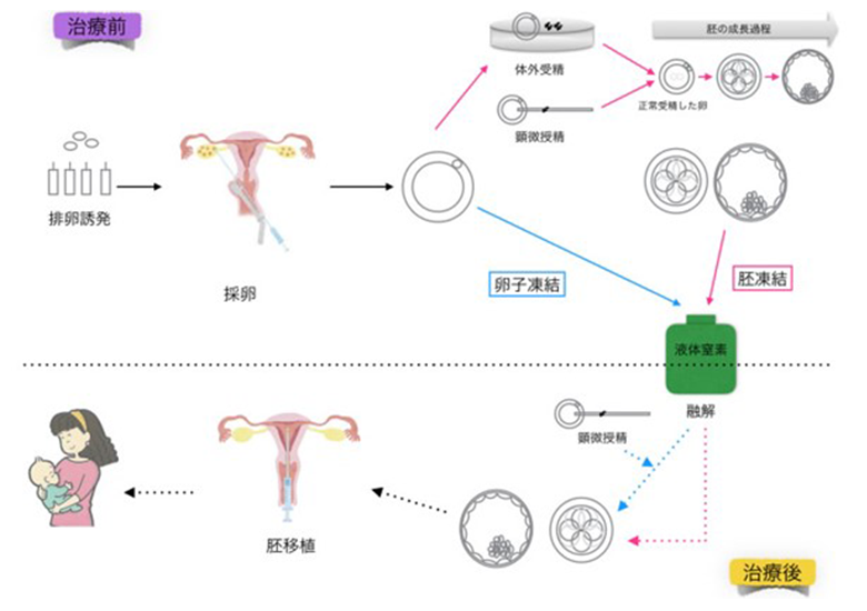 妊孕性温存治療