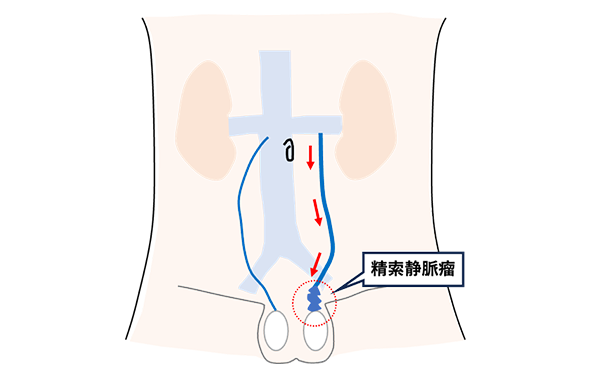 精索静脈瘤