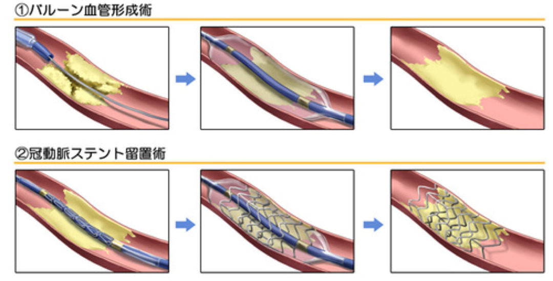 バルーン血管形成術と冠動脈ステント留置術のイメージイラスト