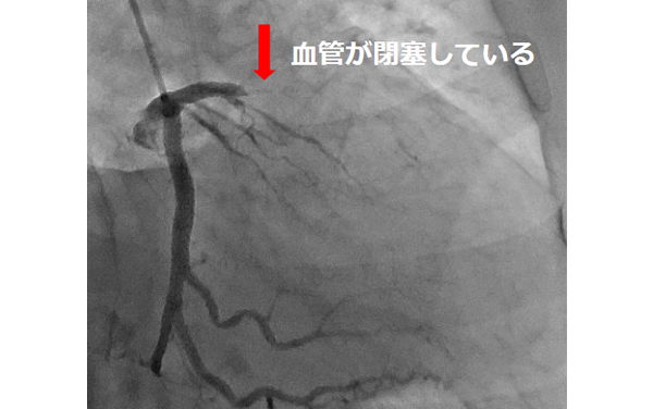 血管が閉塞している様子