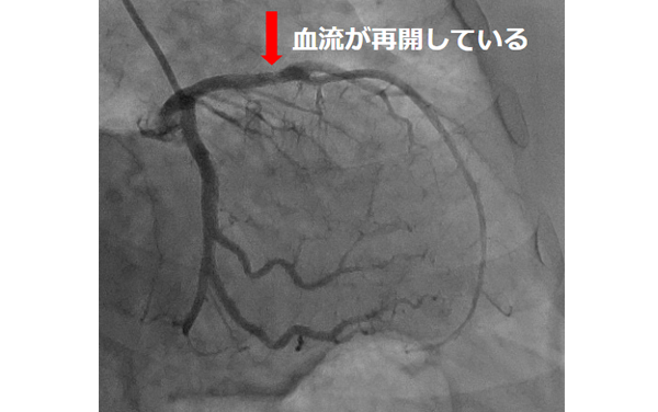 血管が再開している様子