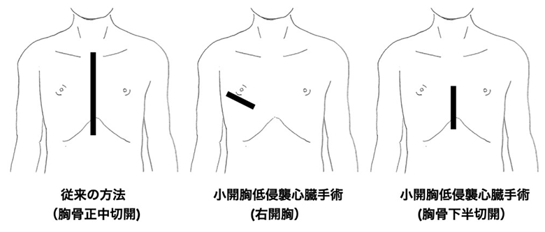 MICS（ミックス）説明図