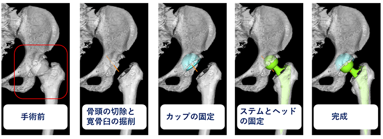 人工股関節全置換術の流れ