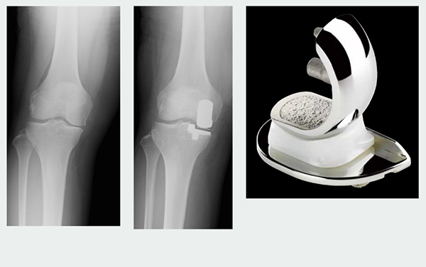 人工膝関節内側単顆置換術（UKA）