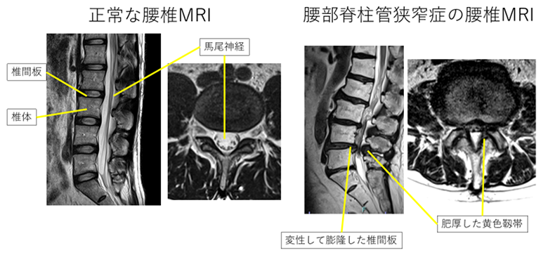 正常な腰椎MRIと腰部脊柱管狭窄症の腰椎MRI