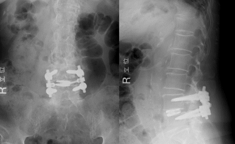 腰椎椎体間固定術（1椎間固定）