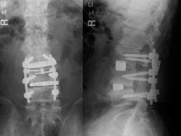腰椎椎体間固定術（2椎間固定）